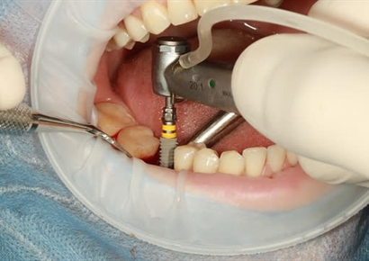 A Q&A With Spotimplant, a Dental Implantology AI